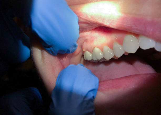 Best Emergency Care for Gum Disease in Long Lake, IL