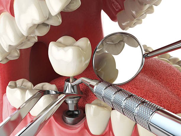 Best Emergency Denture Repair in Long Lake, IL